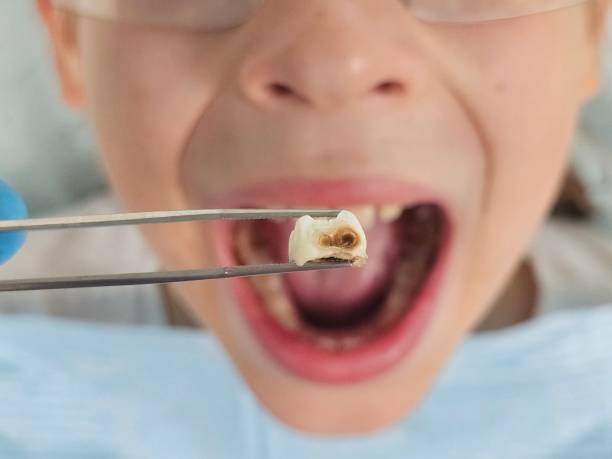 Best Cracked Tooth Emergency Dentist  in Johnson City, TN
